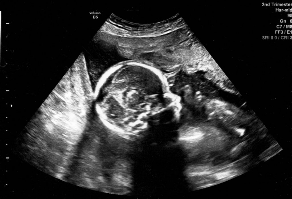 Second trimester ultrasound discovers subchorionic hematoma as reason for pregnancy bleeding